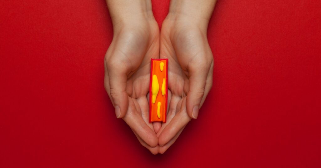 Atherosclerosis of blood vessels. Cholesterol in the arteries. Thrombosis treatment.