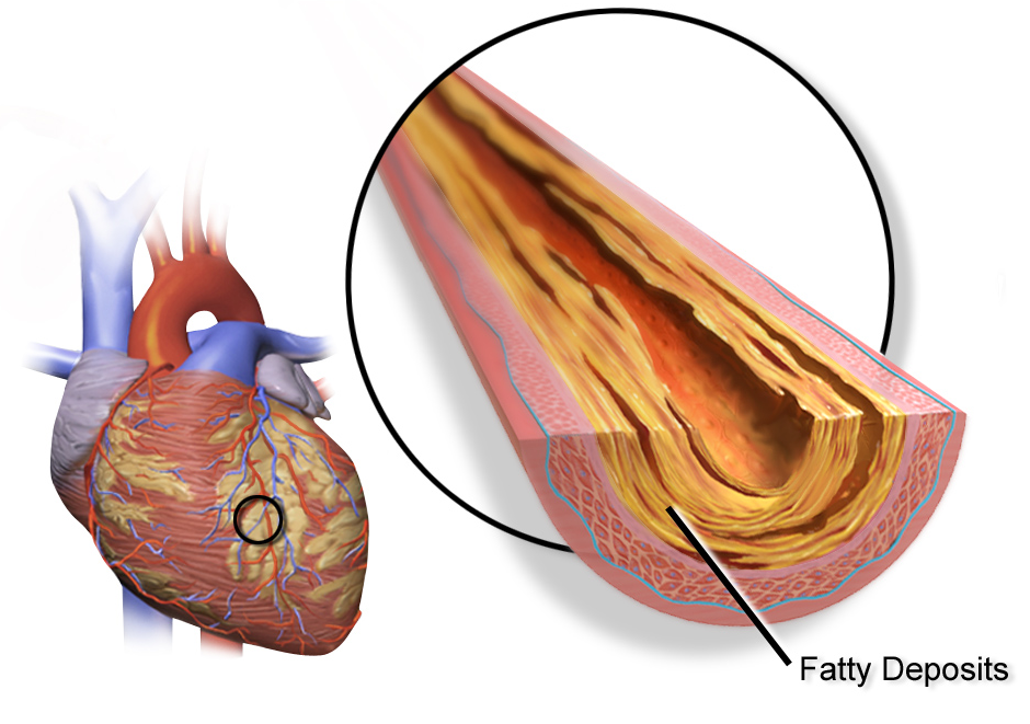 Medical illustration showing coronary artery with fatty plaque deposits that can trigger a heart attack.